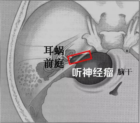 听神经瘤位置示意图,红框部分为内听道.