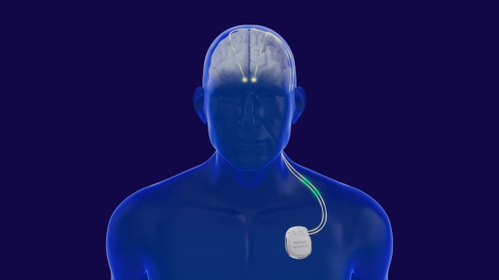 可充电、可感知闭环脑起搏器Percept™ RC工作原理示意图 可充电、可感知闭环脑起搏器Percept™ RC工作原理示意图